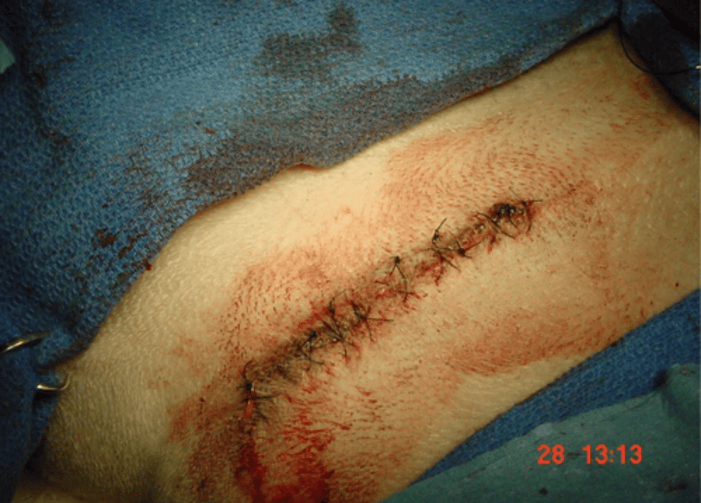 <p>when considering technique for a scrotal ablation, what are two important things to keep in mind</p>