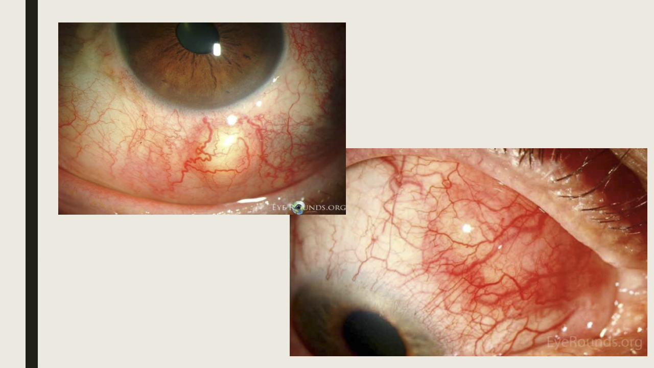 <ul><li><p>Topical or systemic NSAIDs</p></li><li><p>Systemic corticosteroids</p></li><li><p>Systemic immunosuppressive medications (has lost of SE/last resort)</p></li><li><p>Conjunctival steroid injection for multiple episodes </p></li></ul><p></p>
