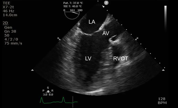 <p>TEE midesophageal LAX taken at 120-140 degrees</p><ol><li><p>LA</p></li><li><p>LV</p></li><li><p>AV</p></li><li><p>RVOT</p></li></ol><p></p>
