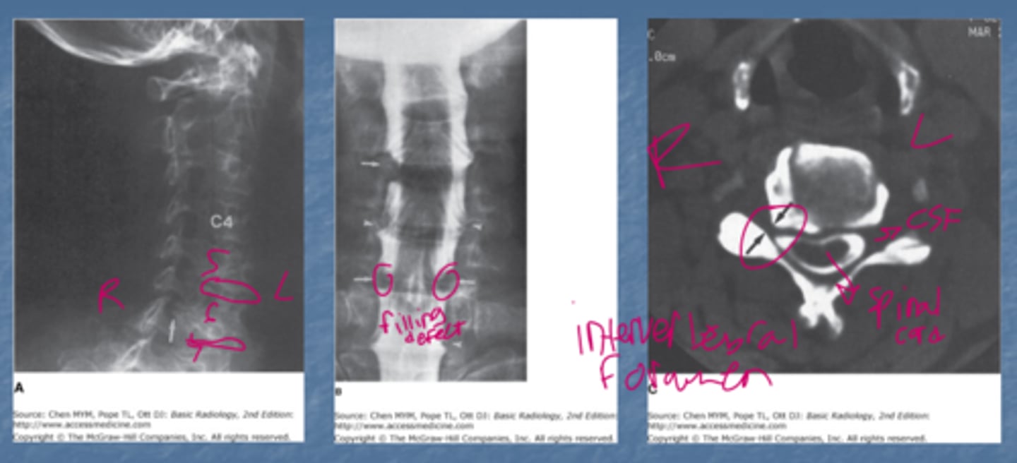 <p>Note that in A there is compromise of the neural foramen by osteophytes. Note the defects where the nerve roots would be on the myelogram.</p>