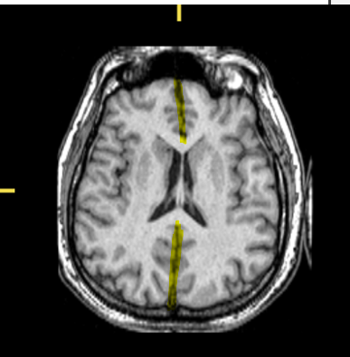 <p>What part of the brain is highlighted?</p>