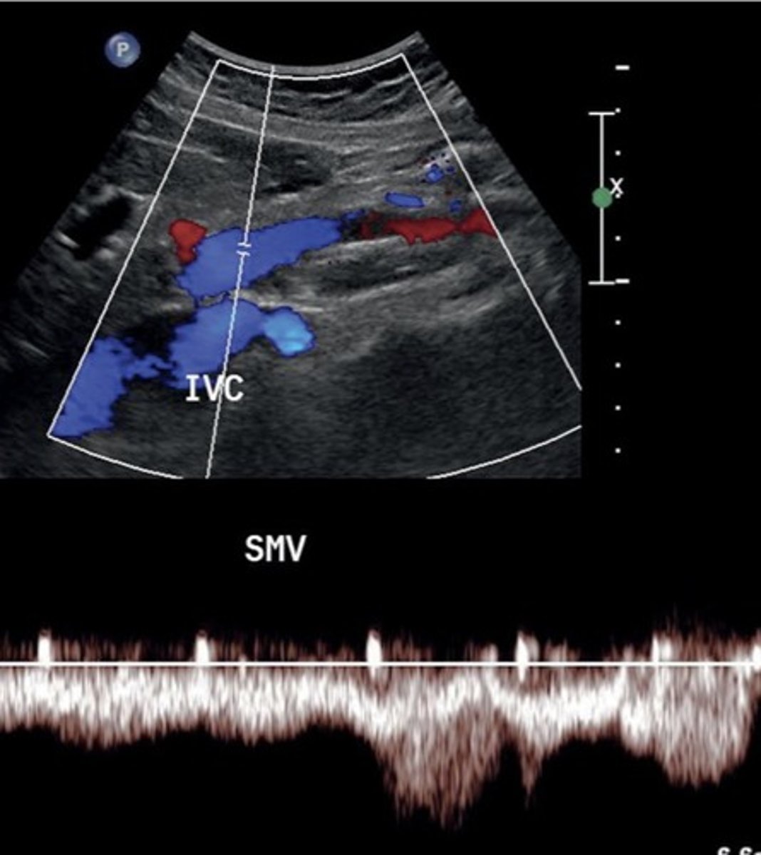 <p>Hepatopetal flow</p><p>Continuous monophasic with slight respiratory variation</p>