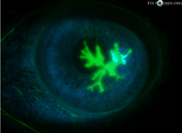<p>What is this fluorescein stain showing?</p>