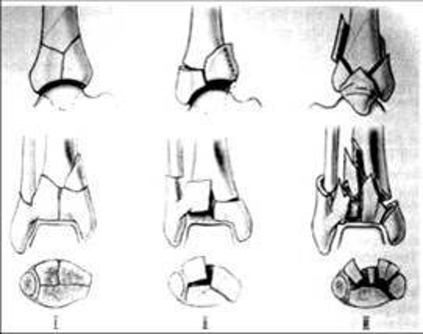 <p>arthritis</p>