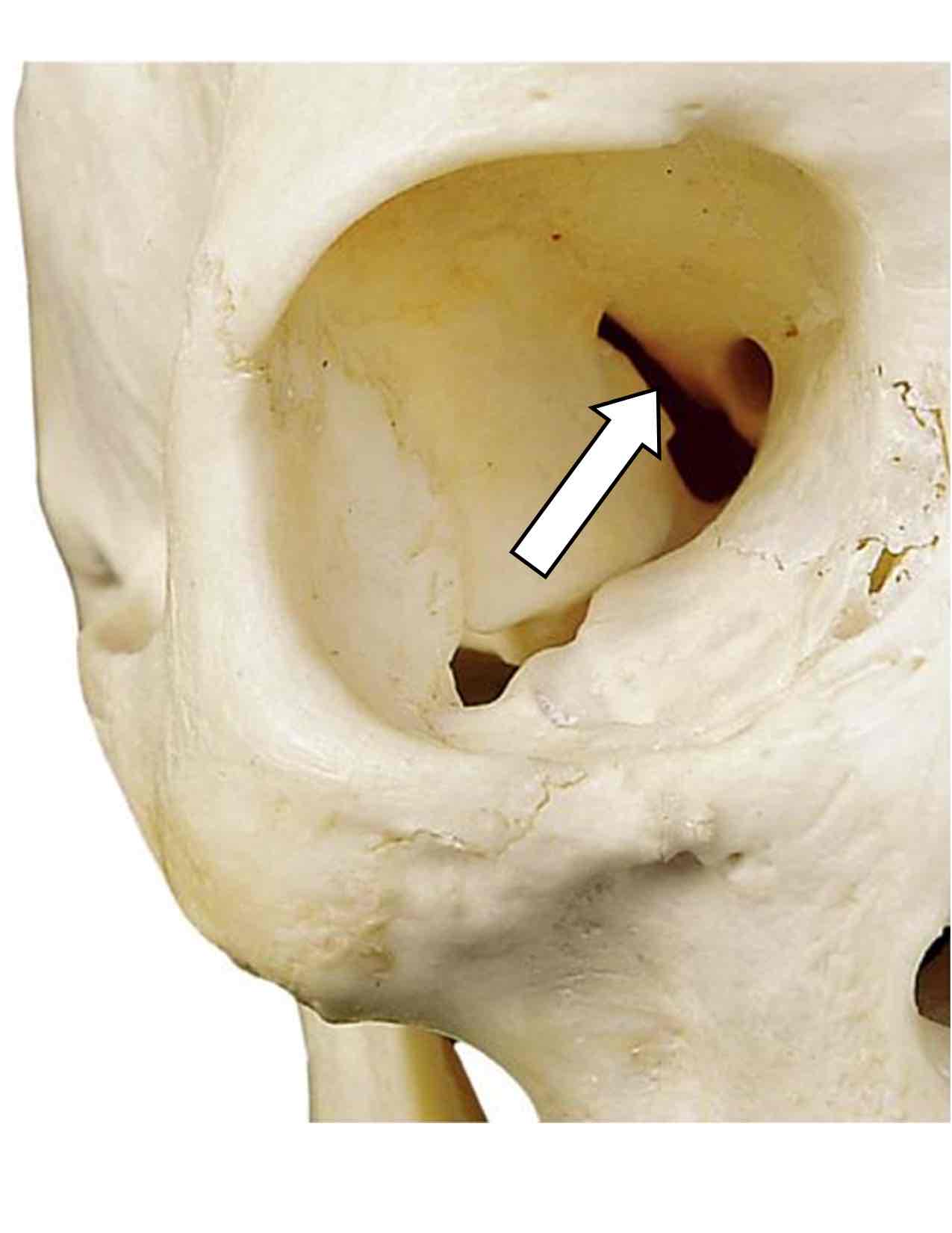 <p>Name the cranial nerves that pass through this hole and their roman numerals</p>