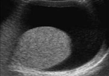 <ol><li><p>The pathology seen here has an idiopathic origin. What can be assumed here?</p></li><li><p>What sonographic finding can be seen amongst the fluid?</p></li></ol><p></p>