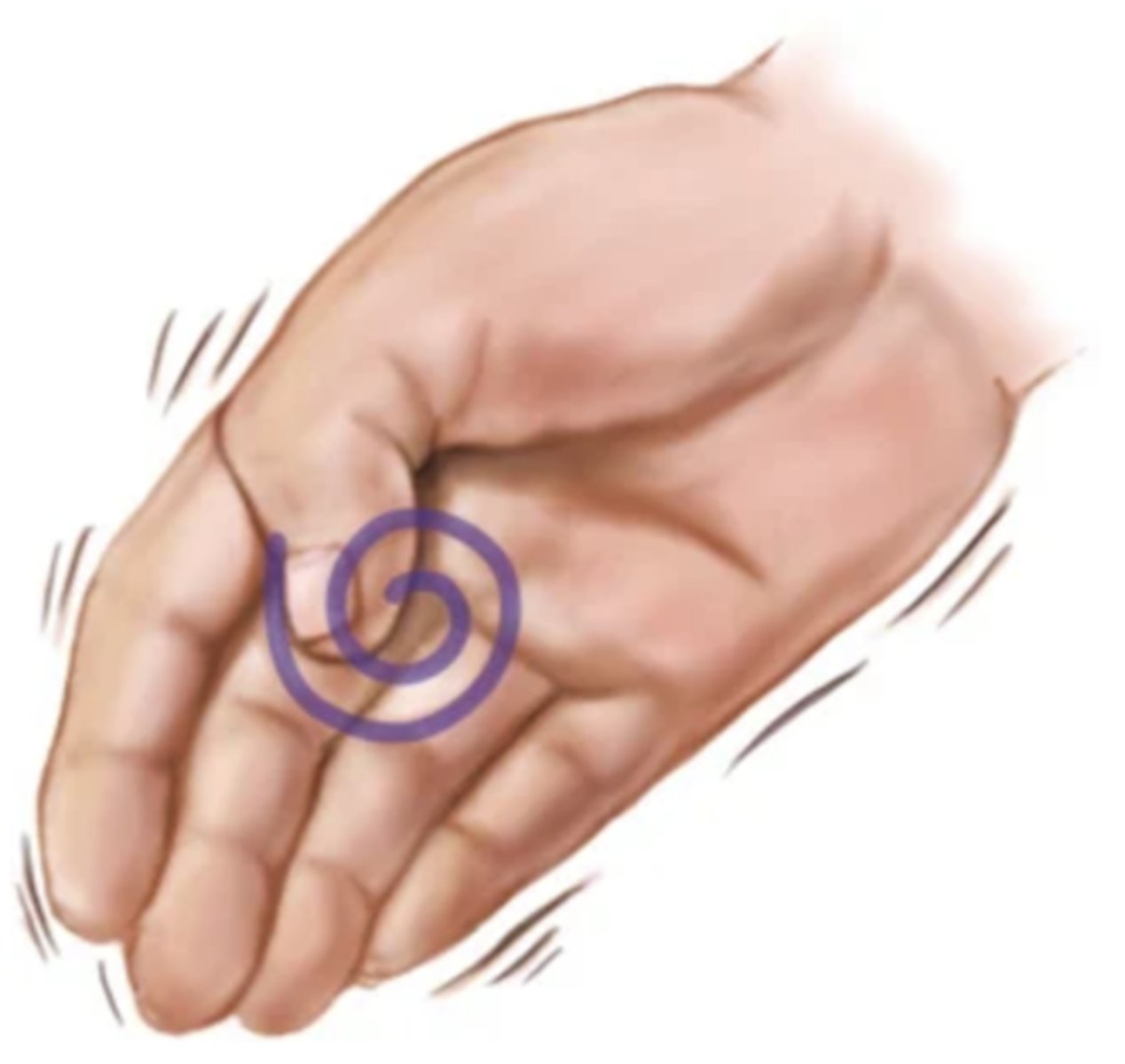<p>Tremor that disappears with voluntary movement</p>