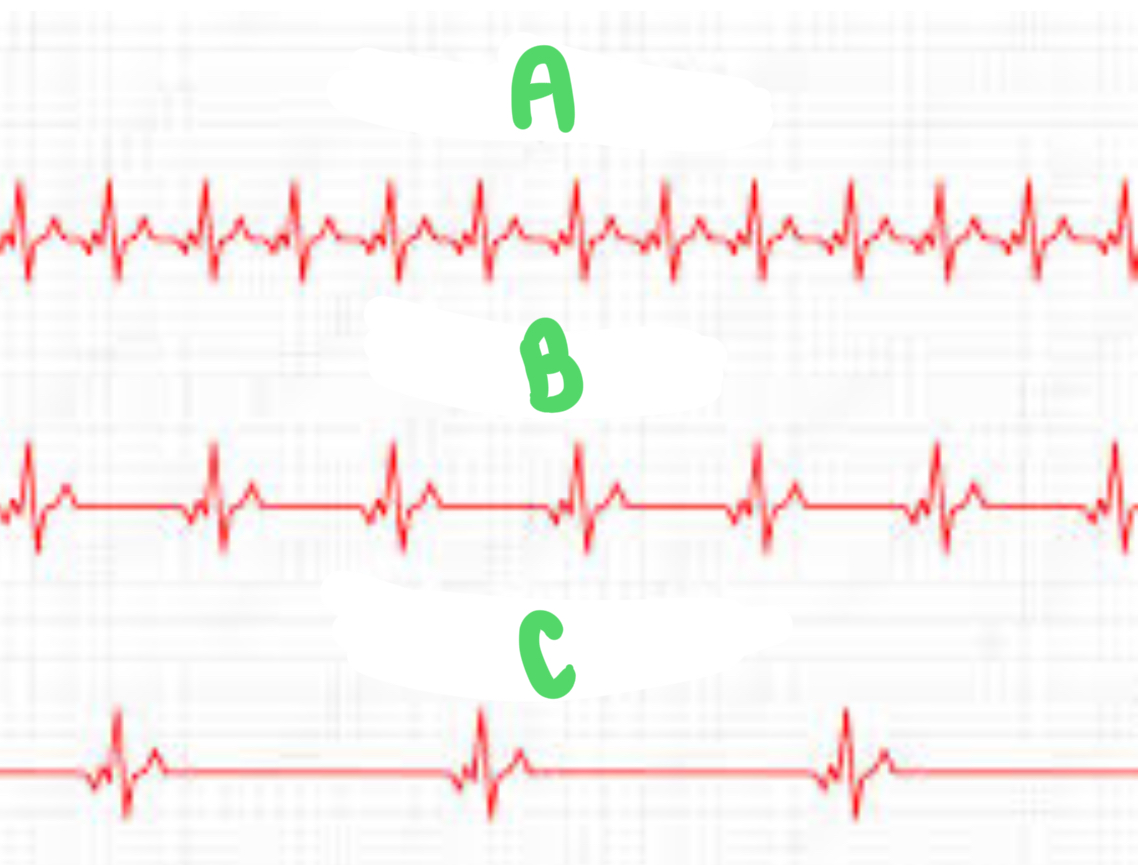 <p>Which EKG is this? Letter B</p>