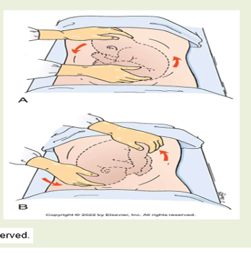 <ul><li><p>Manual turning of at fetus from breech or transverse to vertex <strong>Contraindications </strong></p><ul><li><p>• Multiple fetus e.g. twin</p></li><li><p> • Non-assuring fetal status</p></li><li><p> • Placenta previa </p></li><li><p>• Placenta previa </p></li></ul></li></ul><p><strong>Complications </strong></p><ul><li><p>• Prelabor rupture of membranes</p></li><li><p> • Changes in the fetus's heart rate </p></li><li><p>• Placental abruption • Placenta previa • Preterm labor </p></li><li><p>• PROM </p></li><li><p><u>• Cord prolapse - most common</u></p></li><li><p>• Multiple gestation </p></li><li><p>• Oligohydramnios </p></li><li><p>• uteroplacental insufficiency </p></li><li><p>• fetomaternalhemorrhage </p></li><li><p>• CPD</p></li><li><p> • Nuchalcord</p></li><li><p> • spontaneous conversion back to breech •</p></li><li><p> High rate of cesarean delivery—up to 64%</p></li></ul><p><span style="background-color: transparent; font-size: 1.6rem;">Required assessment before ECV </span></p><ul><li><p><span style="background-color: transparent; font-size: 1.6rem;">• Determine the fetal position</span></p></li></ul><ul><li><p><span style="background-color: transparent; font-size: 1.6rem;"> • Locate the umbilical cord </span></p></li><li><p><span style="background-color: transparent; font-size: 1.6rem;">• Rule out placenta previa </span></p></li><li><p><span style="background-color: transparent; font-size: 1.6rem;">• Detect multiple gestation, oligohydramnios, or fetal abnormalities </span></p></li><li><p><span style="background-color: transparent; font-size: 1.6rem;">• Measure fetal dimensions</span></p></li></ul><p></p><p><em>more successful with oblique than transverse</em></p>