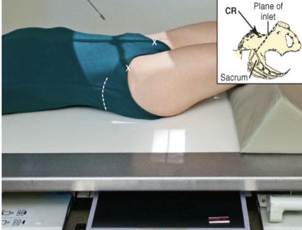 <p>Broad FS, 100cm</p><p>78kVp, 25mAs</p><p>Tube angle 40 degrees caudal</p><p>CR:&nbsp;midline 2-3cm above level of greater trochanter</p>