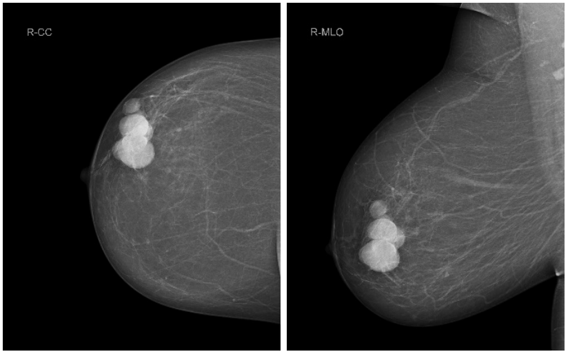 <p>What is shown in this Mammography image?</p>