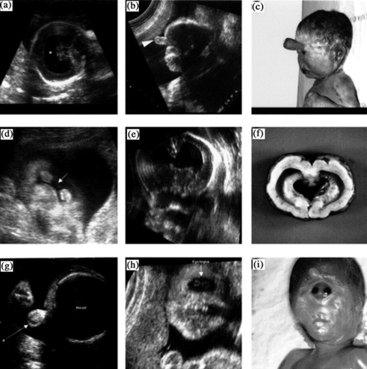 <p>patau syndrome</p>