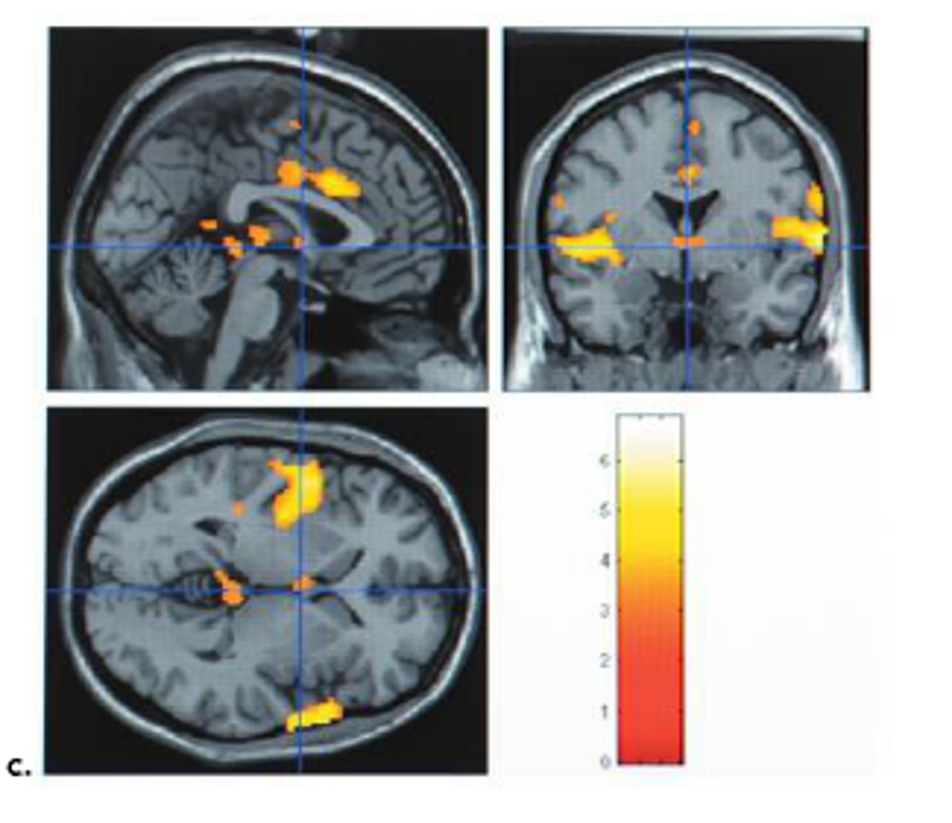 <p>-used to study brain function</p><p>- measures the oxygen content in the blood flowing through each region of the brain (relies on the magnetic properties of the atoms)</p><p>- good spatial resolution</p><p>- bad temporal resolution (i.e. ~ 2 seconds)</p><p>- you can do EEG and MRI at the same time -&gt; but signal is noisy</p>