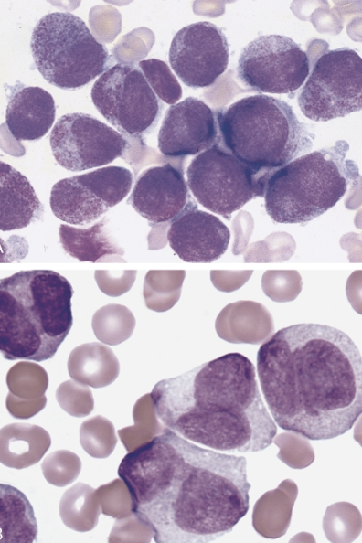 <p>which AML translocation is associated with the following information:</p><ul><li><p>5-10% of AML cases</p></li><li><p>differentiation block at pro stage&nbsp;</p></li><li><p>abnormal hypergranular promyelocytes, some with auer rods (sometimes bundle of auer rods, aka faggot cells)</p></li><li><p><strong>risk of DIC</strong> (release of procoagulant from promyelocytes)</p></li><li><p>a microgranular variant (30-40% of APL cases), may be confused with other AML types (figure B)&nbsp;</p></li><li><p>unique treatment: all-trans-retinoic acid (ATRA) and arsenic trioxide&nbsp;</p><ul><li><p>ATRA induces differentiation of promyelocytes</p></li></ul></li><li><p>the genetic aberration is sufficient for diagnosis regardless of blast count</p></li></ul><p></p>