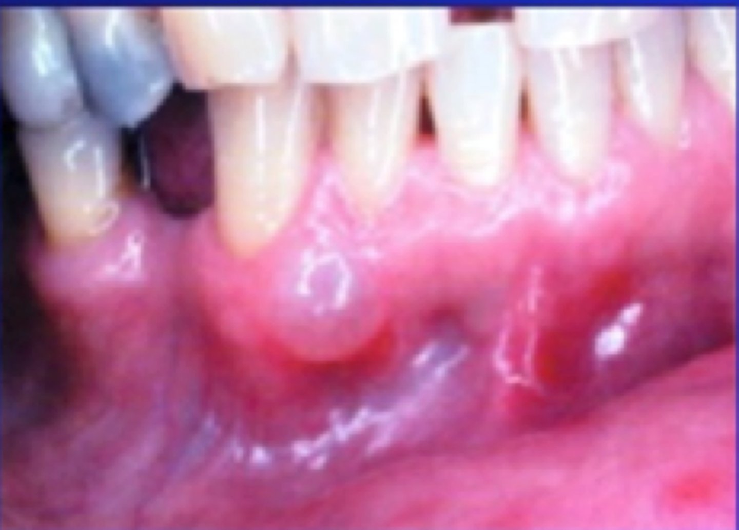 <p>blue-translucent swelling of attached gingiva (Mand canine/premolar area)</p><p>• population: middle-aged adults </p>