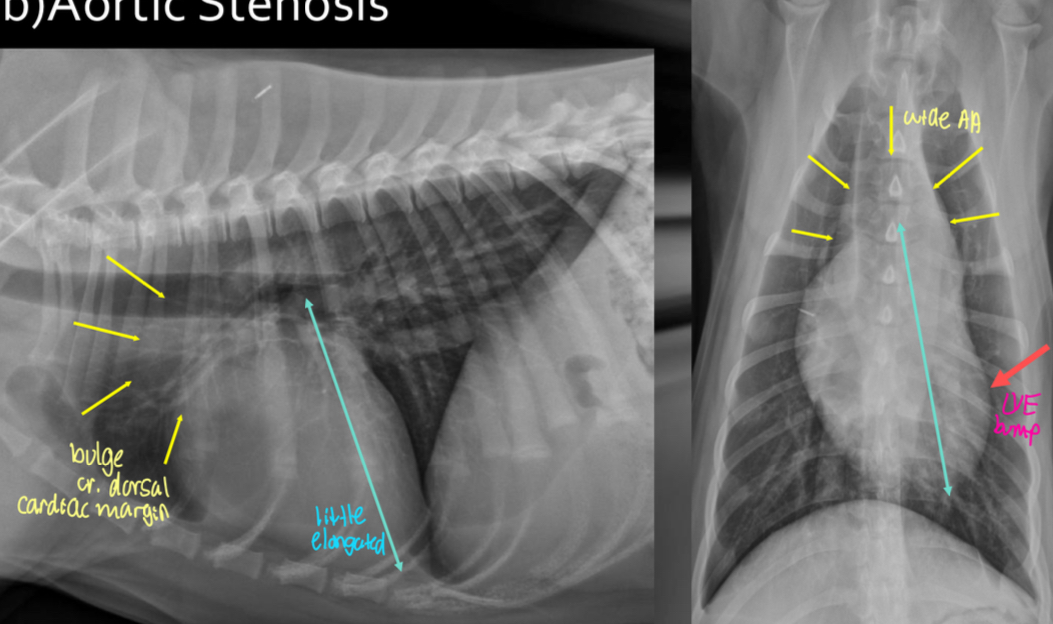 <p>-survey rads could be NORMAL</p><p>-LH enlargement (LVE ± LAE) from PRESSURE OVERLOAD</p><p>-elongated cardiac silhouette</p><p>-AA bump</p><p>-low incidence of LHF</p>