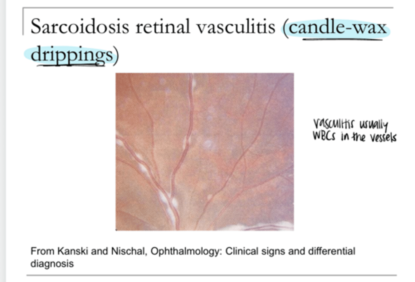 <p>Sarcoidosis Retinal Vasculitis -- Candle-Wax Drippings (Pic)</p>