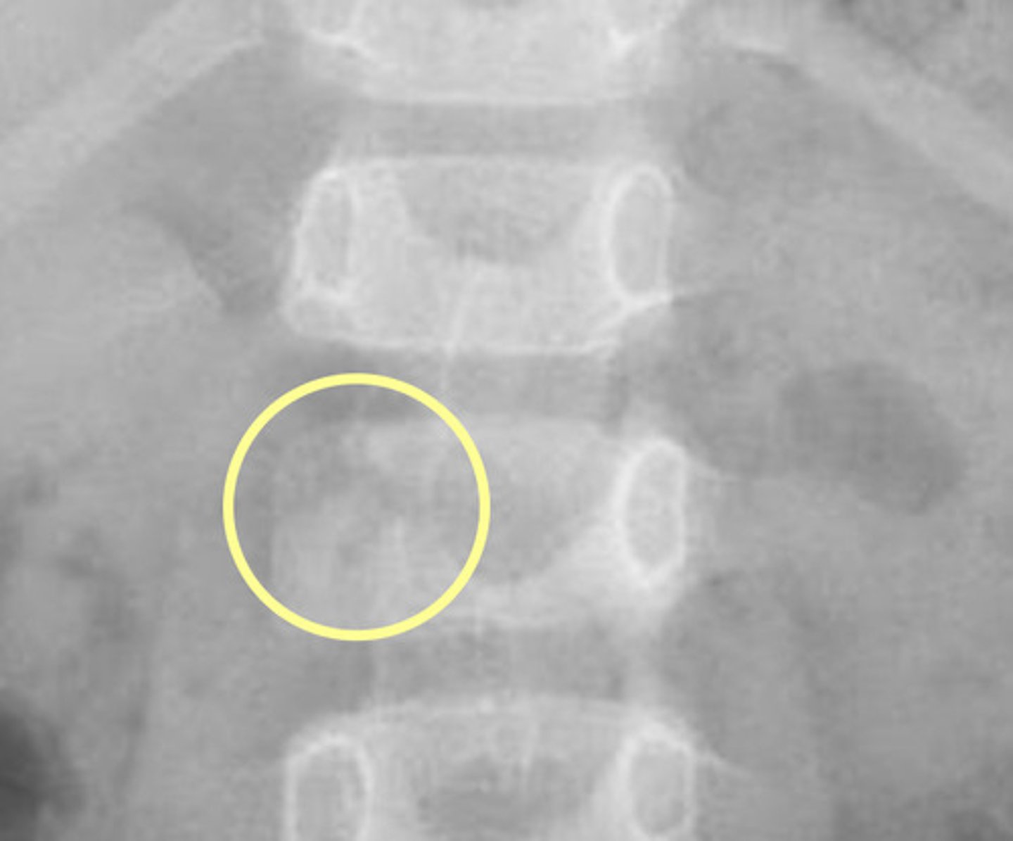 <p>Congenital Absence of a spine pedicle is rare, but important to avoid misdiagnosis >> if not congenital, could be an osteolytic pathology</p><p>"Winking Owl Sign"</p>