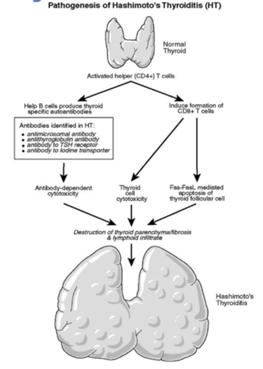 <p>autoimmune disorder in women that destroys the thyroid, causing hypothyroidism</p>
