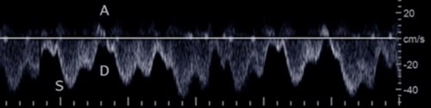 <p>S wave: ventricular systole</p><p>D wave: atrial filling</p><p>A wave: atrial contraction</p><p>Inspiration depresses systolic wave</p><p>Exhalation augments systolic wave</p><p>Valsalva diminishes pulsatility</p>