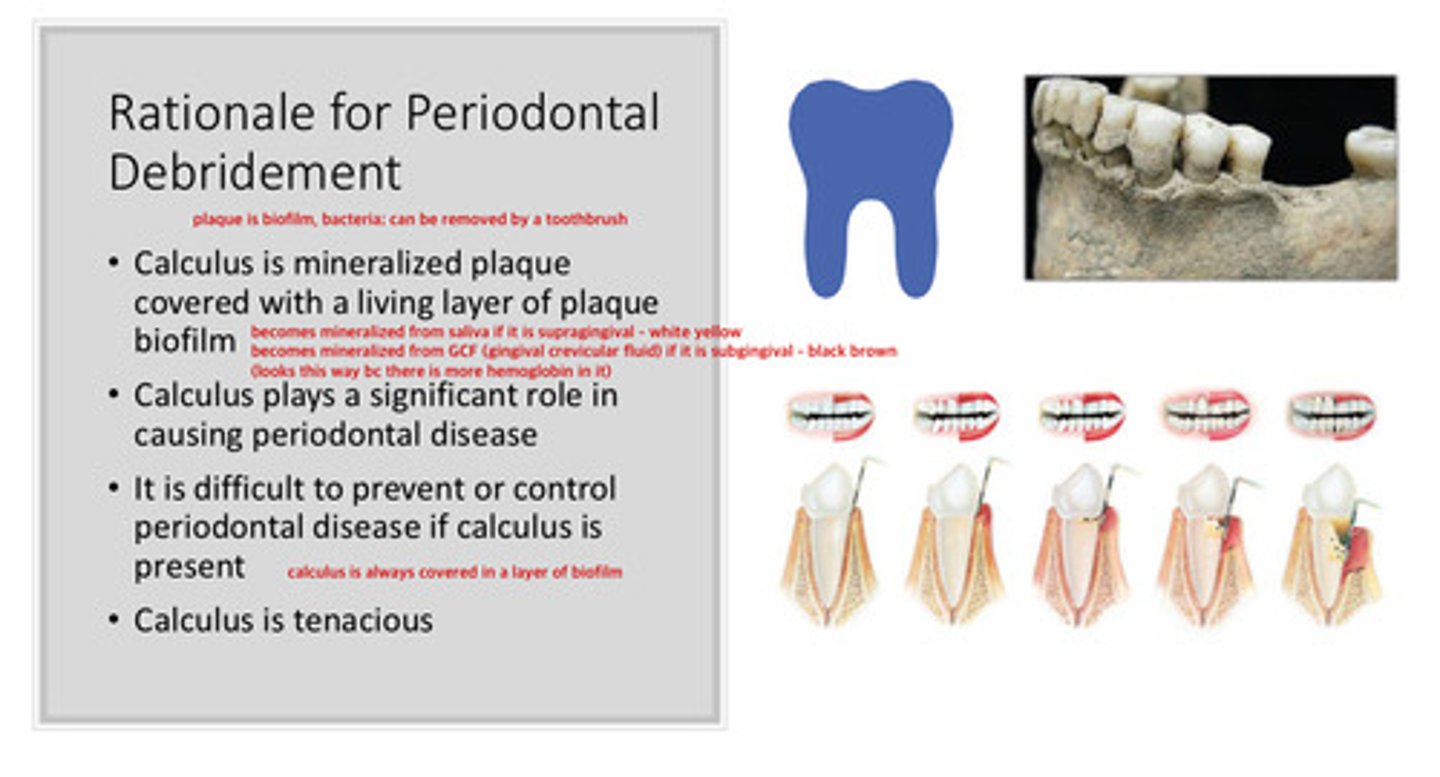 <p>plaque is biofilm, bacteria —> can be removed by a toothbrush</p><p>calculus is mineralized plaque covered with a living layer of plaque bioflim (always is covered in a layer of biofilm)</p>