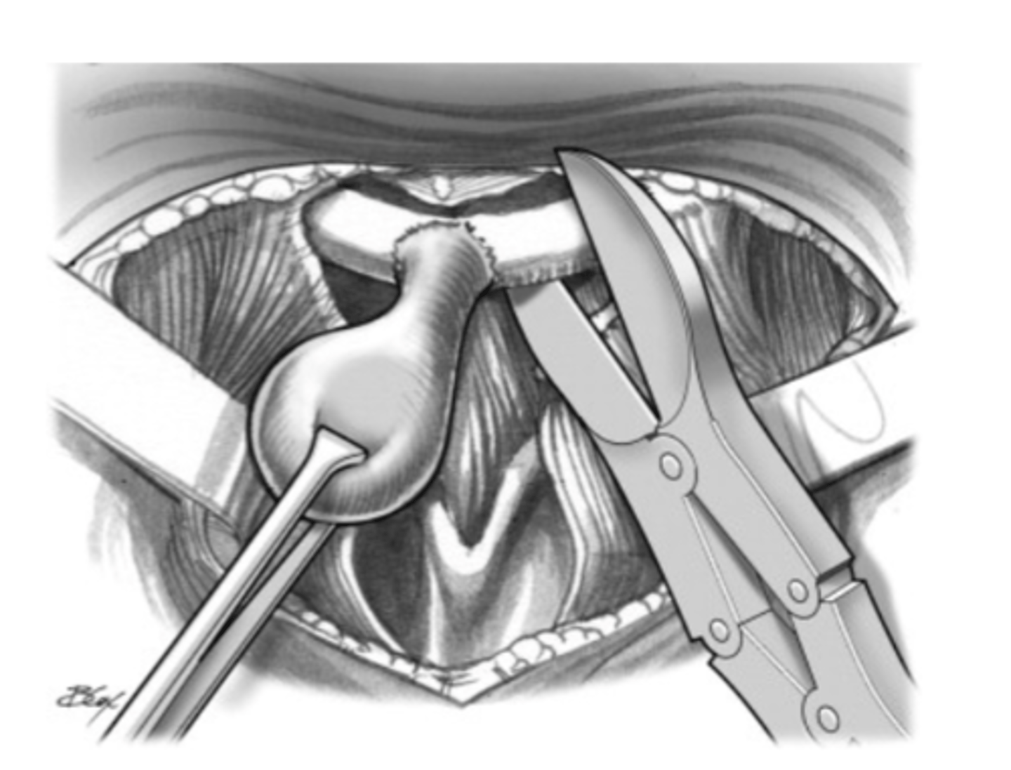 <p>What is the treatment for Thyroglossal duct cyst? </p>