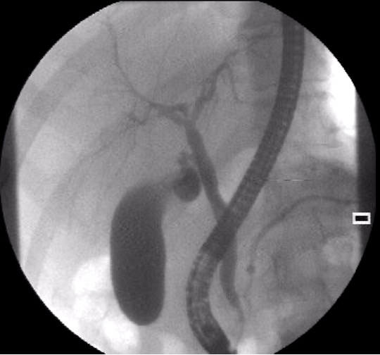 <p>used to identify presence of stones, tumors, or narrowing in biliary and pancreatic ducts</p>