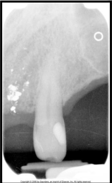 <p>What is this ? → dense radiopacities with irregular borders.&nbsp;</p>