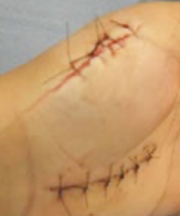 <p>clean, uninfected cutaneous wound with adjacent borders that has minimal tissue damage and allows for epithelial regeneration and minimal scarring</p>