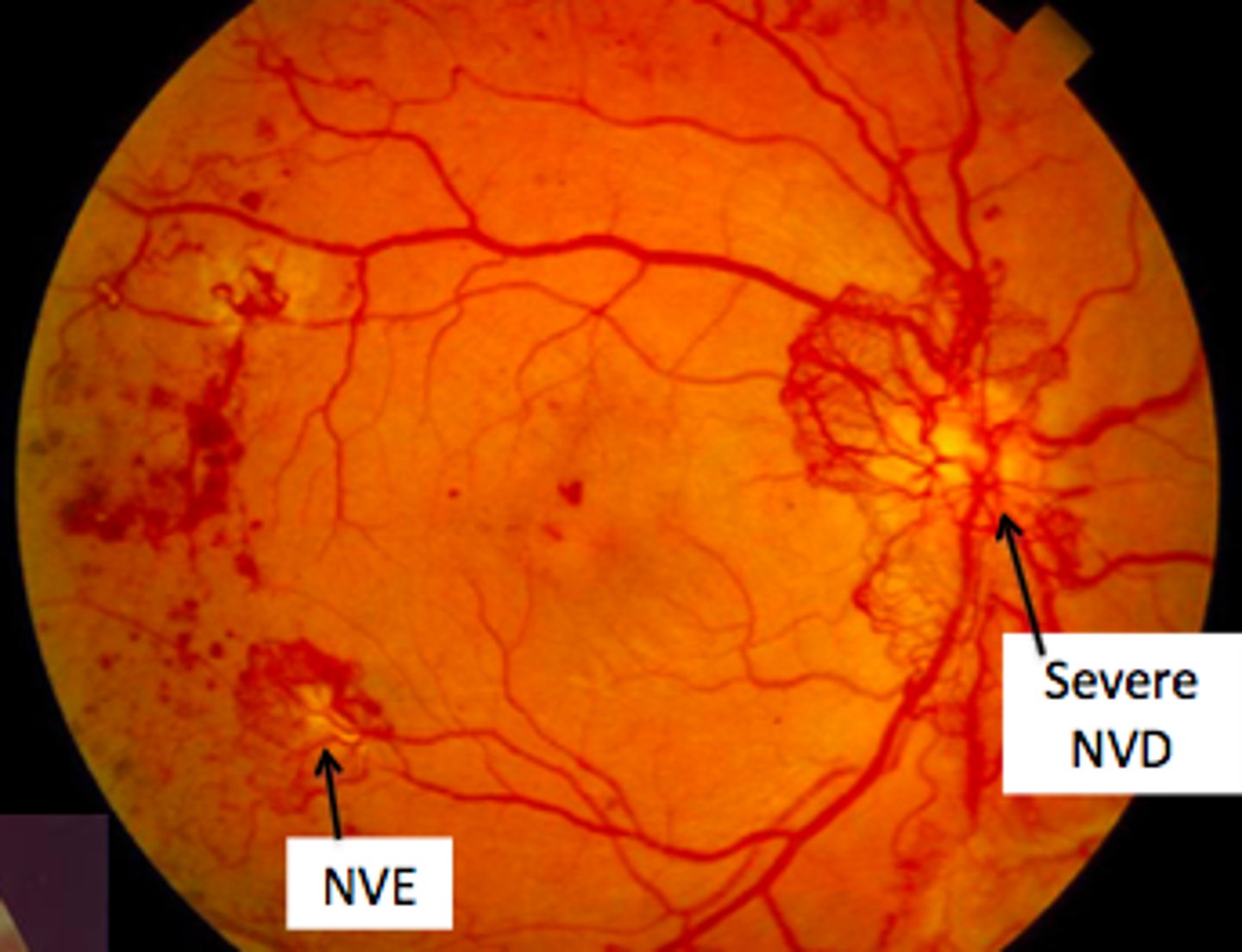 <p>Combination therapy with panretinal photocoagulation and anti-VEGF agents, laser therapy, intravitreal steroids if macular edema is present, and pars plana vitrectomy for progressive disease.</p>