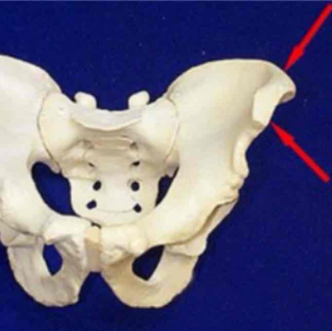 <p>cat #1 / narrow ridge of bone, usually prominent / iliac crest (hip)</p>