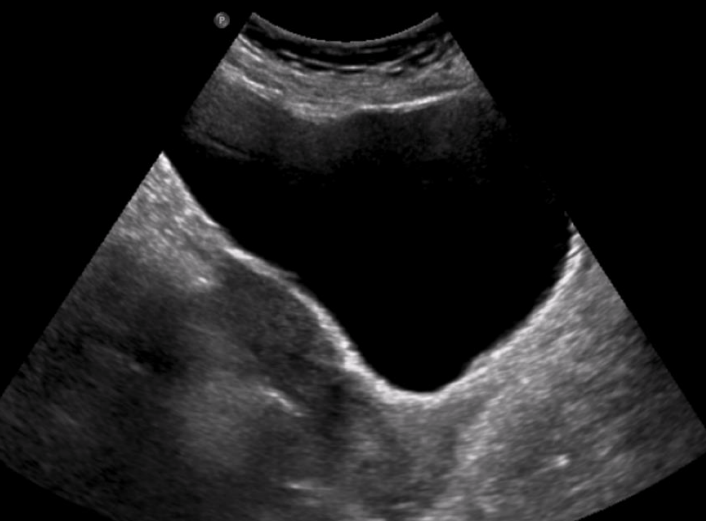 <p>Is this a trans or long image of the bladder?</p>