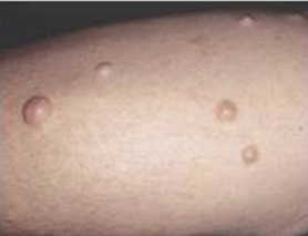 <p>ELEVATED, SOLID, HARD MASS THAT EXTENDS DEEPER INTO THE DERMIS THAN A PAPULE. HAVE A CIRCUMCRIBED BOARDED AND 0.5 TO 2CM</p>