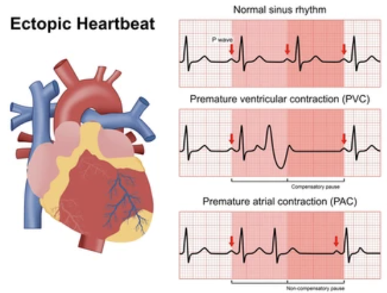 <ol><li><p>Is it regular? </p></li><li><p>Is it irregular?</p></li><li><p>Are there any patterns to the irregularity?&nbsp;</p></li><li><p>Are there any ectopic beats? If so are they early or late?&nbsp;</p></li></ol><p></p>