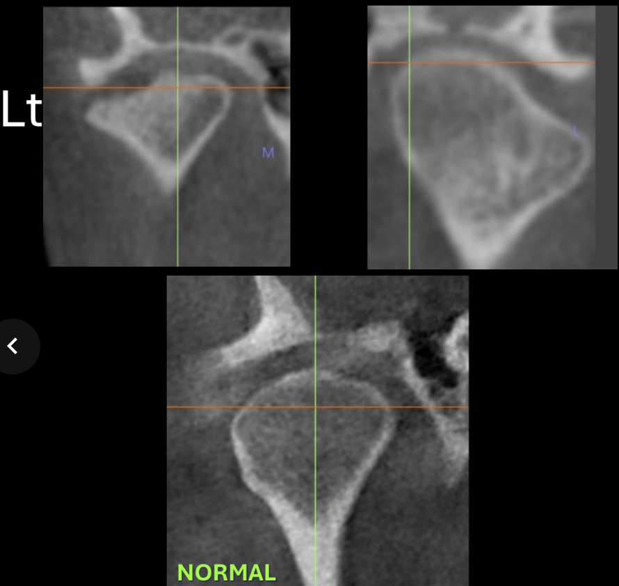 <p>The convexity is disrupted (becomes concave), left side cortical borders are interrupted, visible bone spurs</p>