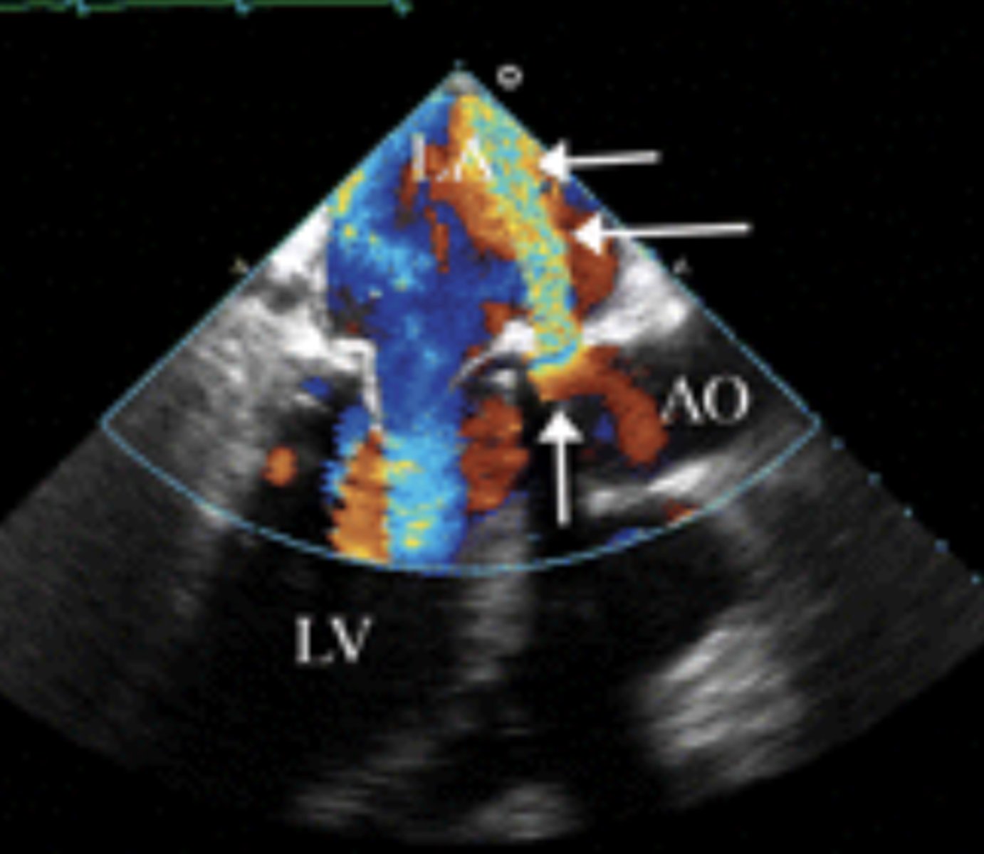 <p>Between LV &amp; RA</p><p>Between LV &amp; left coronary artery</p><p>Between LA &amp; aorta</p>
