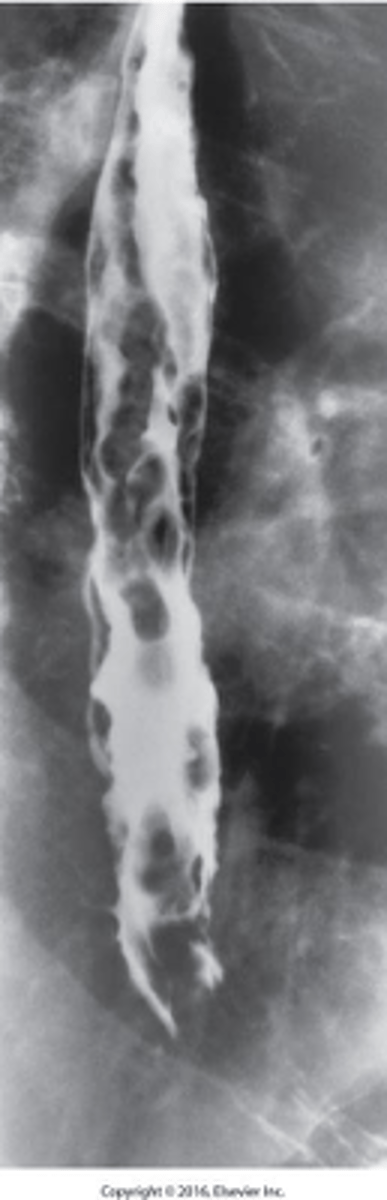 <p>What is Esophageal Varices ?</p>