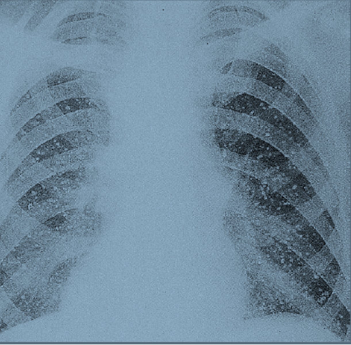 <p>a disease that results from the inhalation of an airborne fungus (often from bird or bat droppings) that can affect the lungs (usually presents as pneumonia) and may spread to other organs</p>