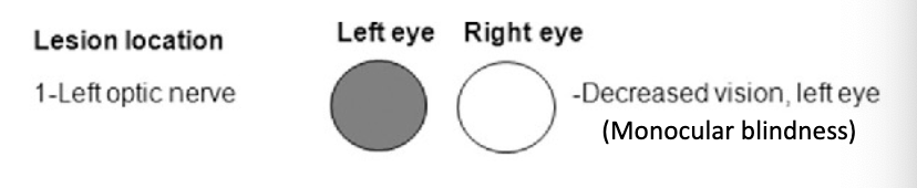 <p>distal optic nerve lesion</p><p>results in monocular blindness</p>