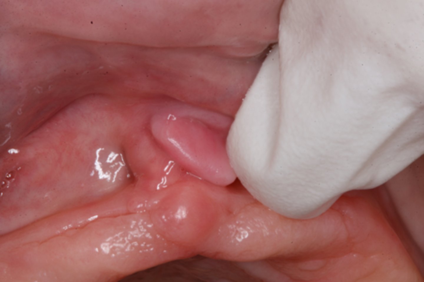 <p>inflammatory fibrous hyperplasia</p>