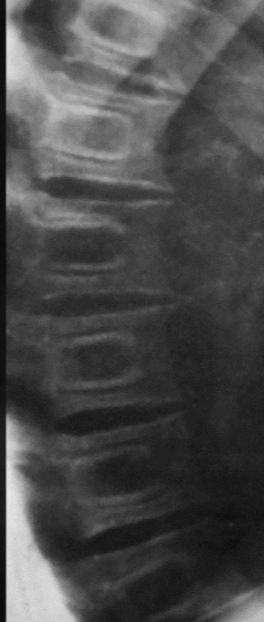 <p>what is seen here for this case of osteopetrosis?</p>