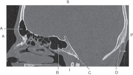 <p>Which line points to the frontal sinus?</p>