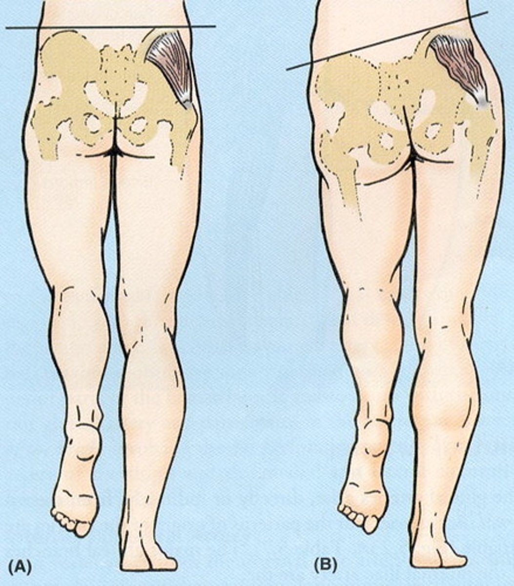 <p>- diagnosis: weakness of hip abductors (gluteus medius)</p><p>- how: stand 1st on one leg &amp; then the other</p><p>+ = abductor weakness in stance leg if opposite iliac crest drops</p>