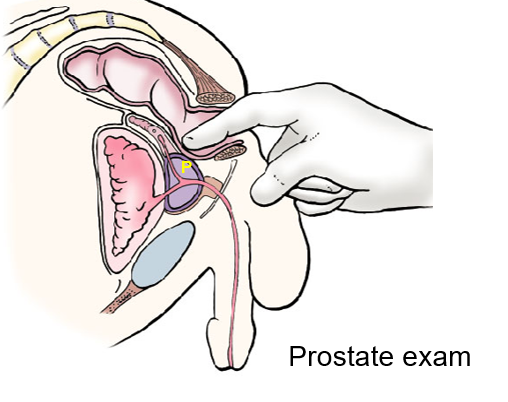 <p>benign prostatic hyperplasia or BPH</p><ul><li><p>enlargement in middle aged and older males @ transition zone (surrounds urethra)</p></li><li><p>Symptoms: nocturia, urgency, and dysuria</p></li></ul><div data-type="horizontalRule"><hr></div><p>Prostate Cancer:</p><ul><li><p>Elderly males in peripheral Zone </p></li><li><p>The area posterior (P) to urethra &amp; inferior to ejaculatory duct is palpable by digital rectal examination. </p></li><li><p>can spread to spine &amp; CNS via vertebral venous plexuses. </p></li></ul><p></p>