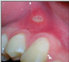 <p>Minor Recurrent Aphthous Ulcer</p>