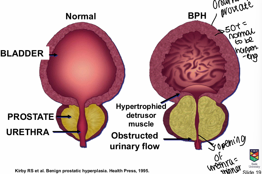 <p>Growth of prostate/bladder thicken, hypertrophied detrusor muscle, urethra opening is thinner </p>