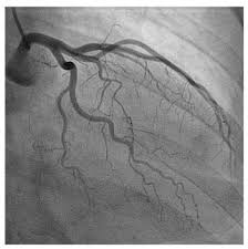 <p>Pt Prep for Angio procedures (peripheral or coronary)</p>