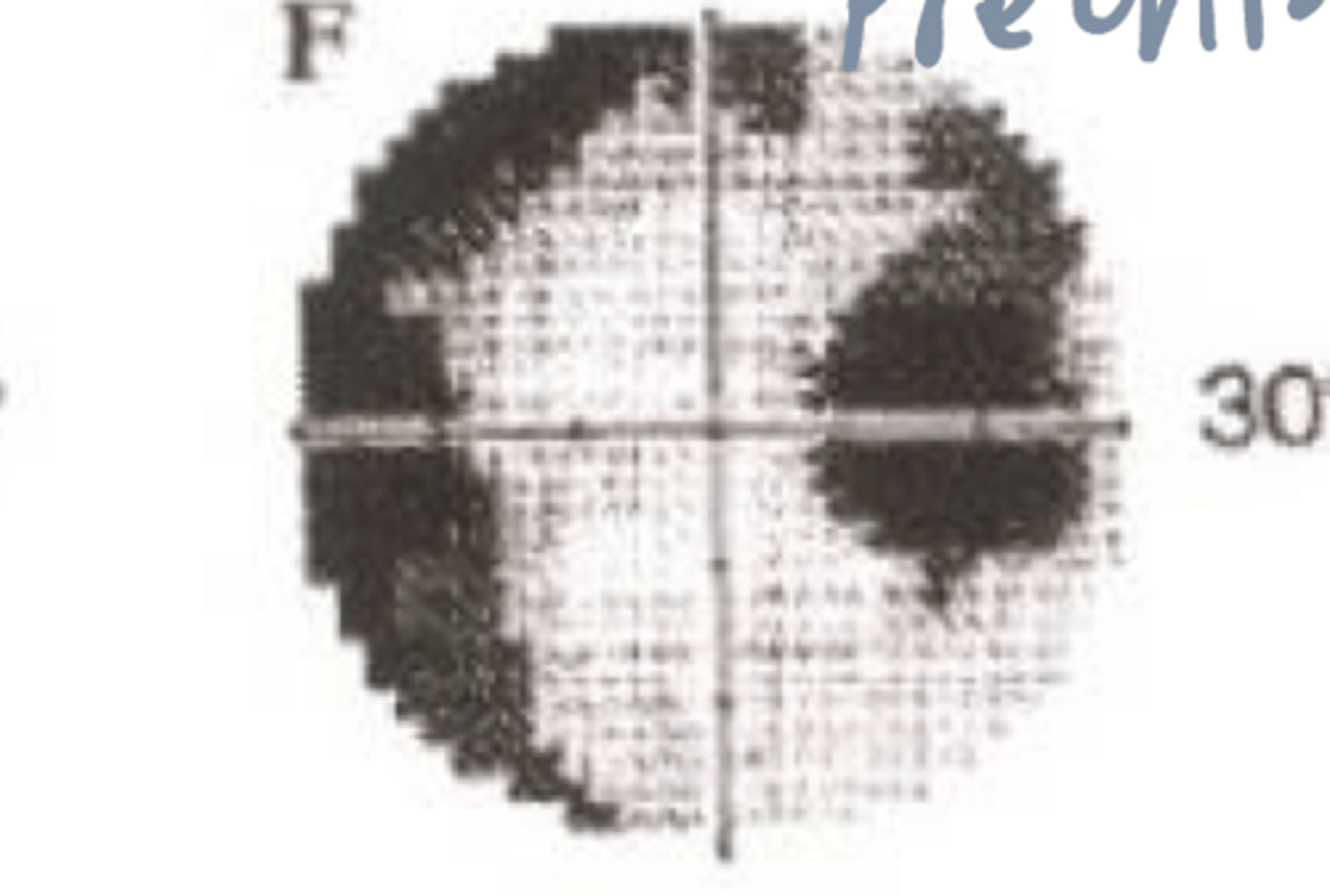 <p>What type of monocular pre-chiasmic VF defect is present in the given image?</p>