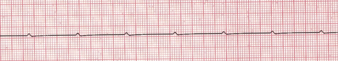 <p>P waves only; can be present in paroxysmal episdoes</p>