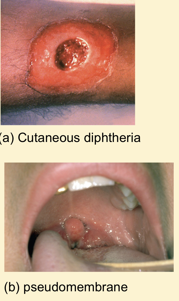 <p></p><ul><li><p>First stage of diphtheria</p></li><li><p>Upper respiratroy tract inflammation; primary infection</p><ul><li><p>Sore throat, nausea, vomiting, swollen lymph nodes</p></li><li><p>Pseudomembranes can cause asphyxiation</p></li></ul></li><li><p>Cutaneous diphtheria; secondary infection</p></li></ul>